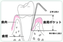 歯周病(歯ぐき)の検査