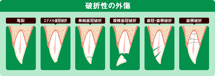 破折性の外傷