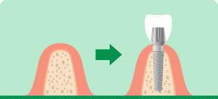 インプラント