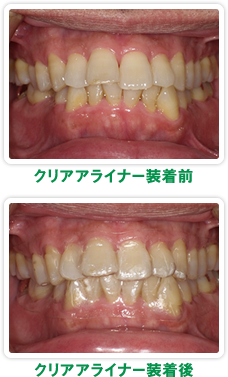 クリアアライナー