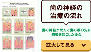 歯の神経が死んで歯の根の先に感染を起こした場合