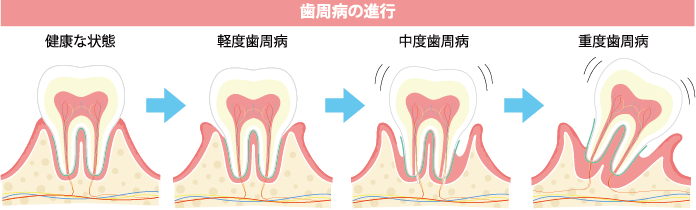 歯周病の進行