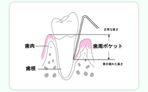 歯周病(歯ぐき)の検査