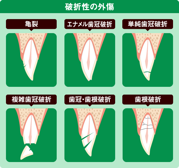 破折性の外傷