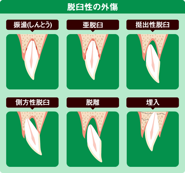 脱臼性の外傷