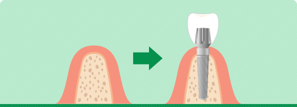 インプラント