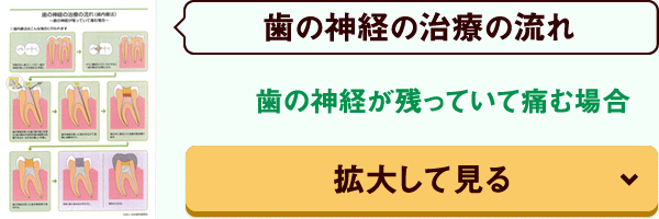 歯の神経が残って痛む場合