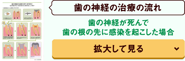 歯の神経が死んで歯の根の先に感染を起こした場合