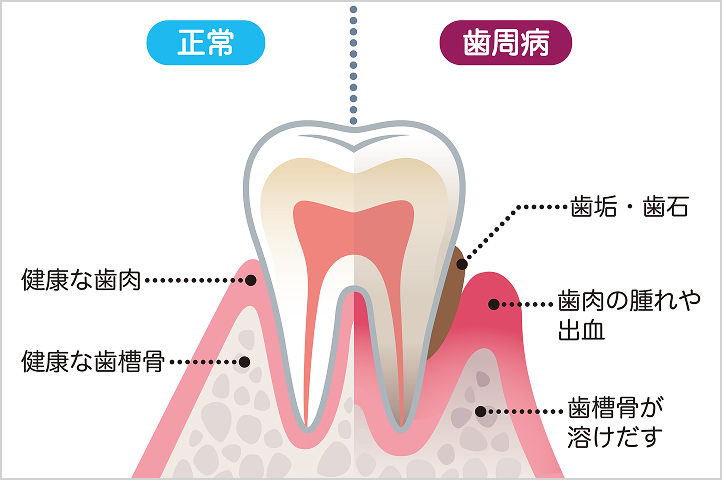 歯周病(歯ぐき)の検査