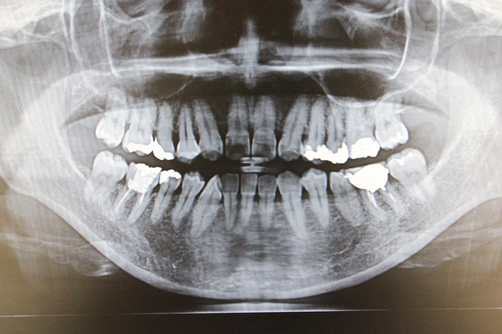 レントゲン撮影