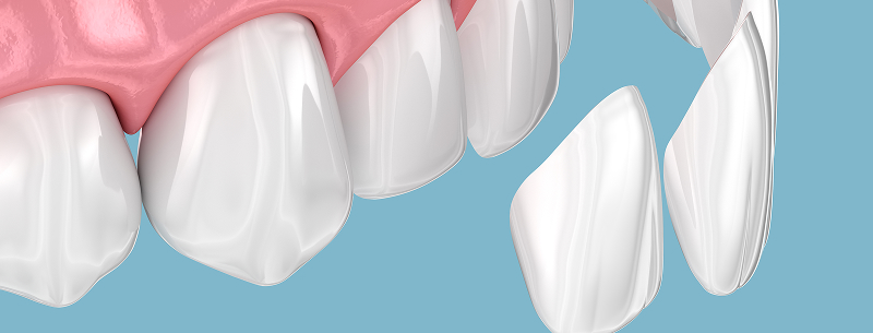 セラミック治療とは