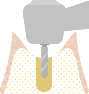 手術