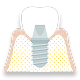 人工的な歯根に人工的な歯をかぶせます