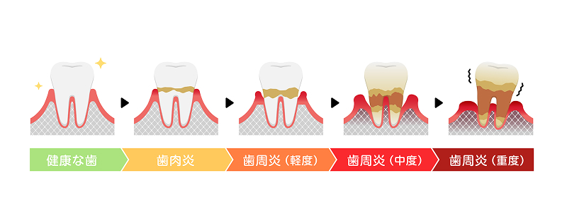 歯周病の治療